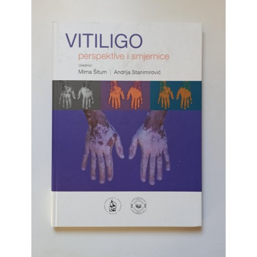 Vitiligo - Perspektive i smjernice
